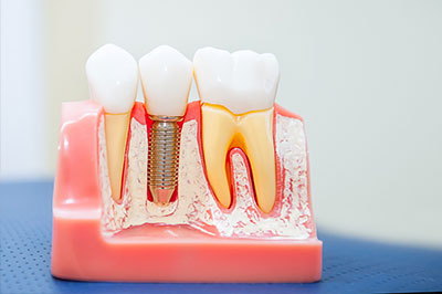 Uyesugi Dental | Oral Exams, Ceramic Crowns and Laser Dentistry