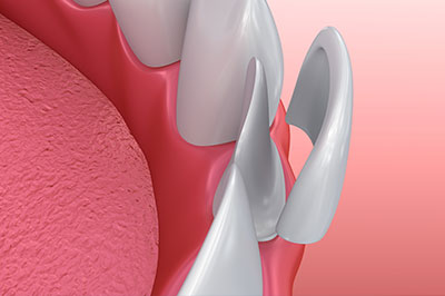 Uyesugi Dental | ZOOM  Whitening, Intraoral Camera and Sedation Dentistry