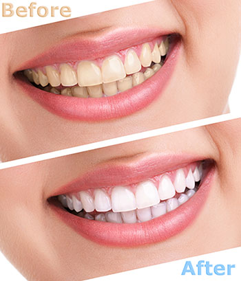 Uyesugi Dental | Veneers, Cosmetic Dentistry and Dental Cleanings